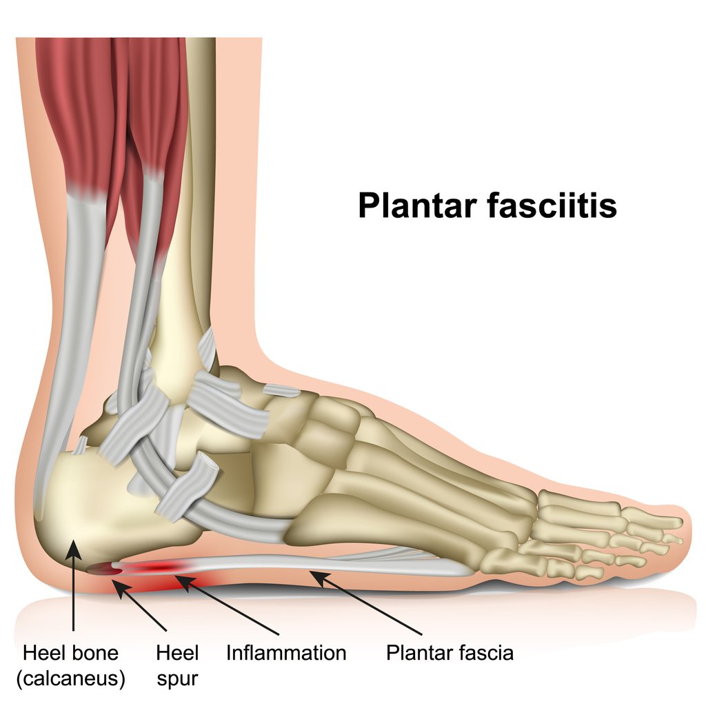 plantar fasciitis 3d medical vector illustration