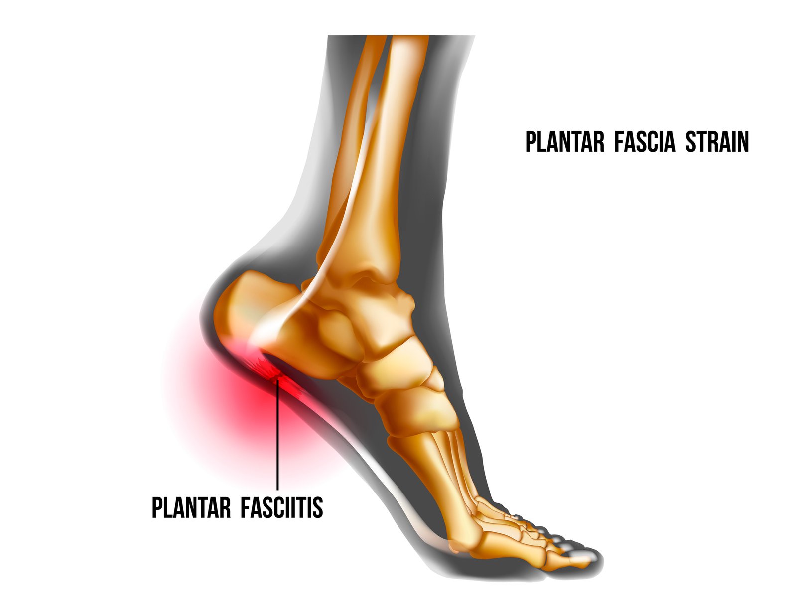 plantar fasciitis tenderness illustration