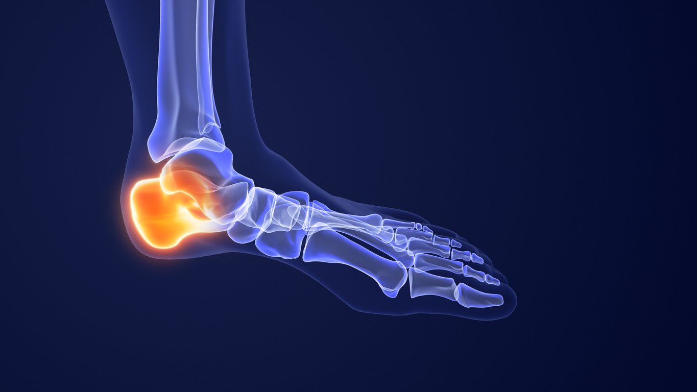 Plantar Fasciitis with Calcaneal Spur: Symptoms, Diagnosis & Treatments ...