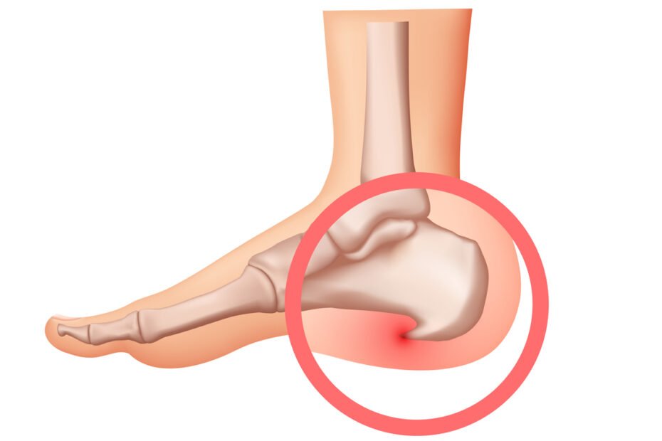 plantar fasciitis pain illustration