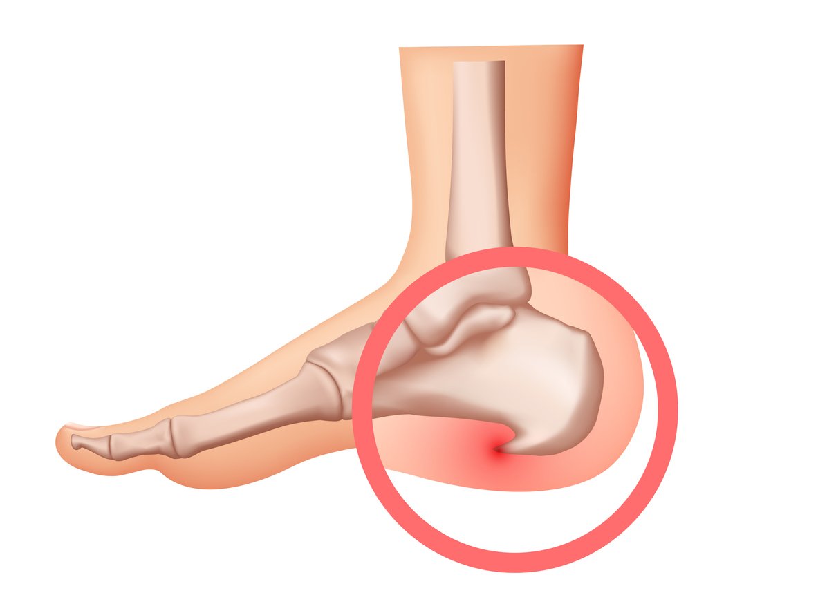 plantar fasciitis pain illustration