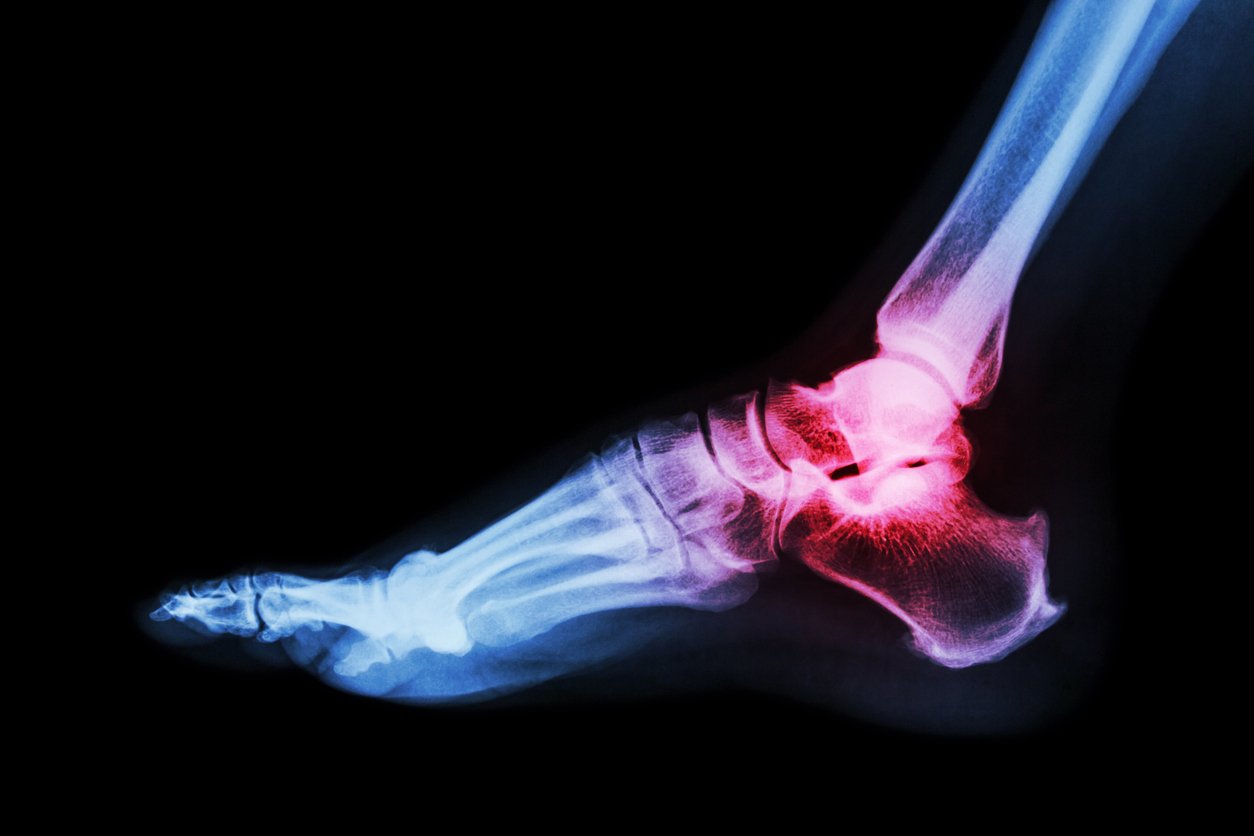 Plantar Fasciitis X Ray