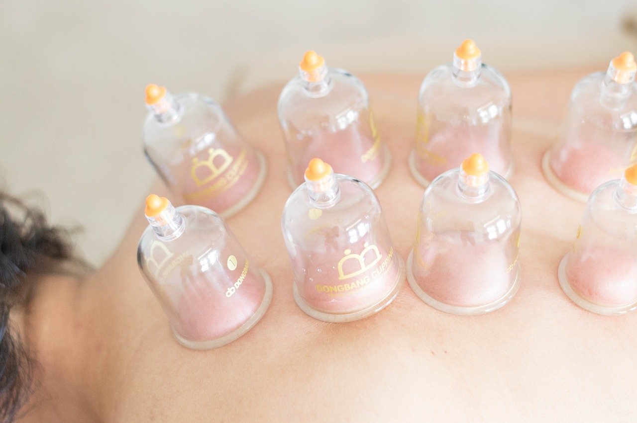 Cupping for Plantar Fasciitis